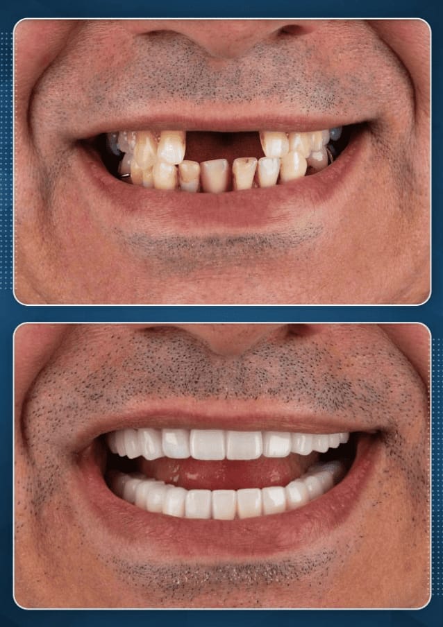 Full mouth rebuild — implants and ceramic crowns